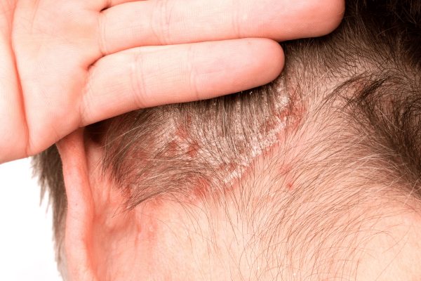 ¿Tiene cura la dermatitis seborreica? Esto dicen los expertos
