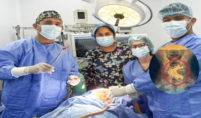 Adulto mayor se tragó su dentadura postiza, en Perú