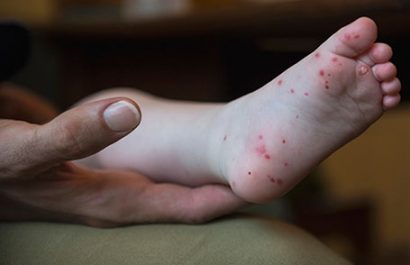 hfmd-childs-foot