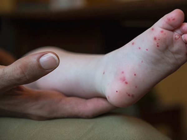 hfmd-childs-foot
