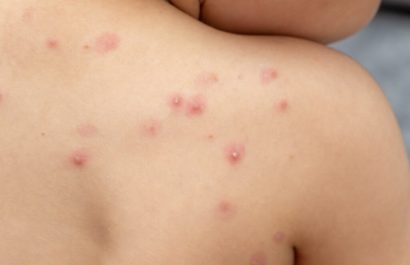 la-viruela-del-mono-sigue-siendo-una-emergencia-de-salud-publica-de-preocupacion-internacional