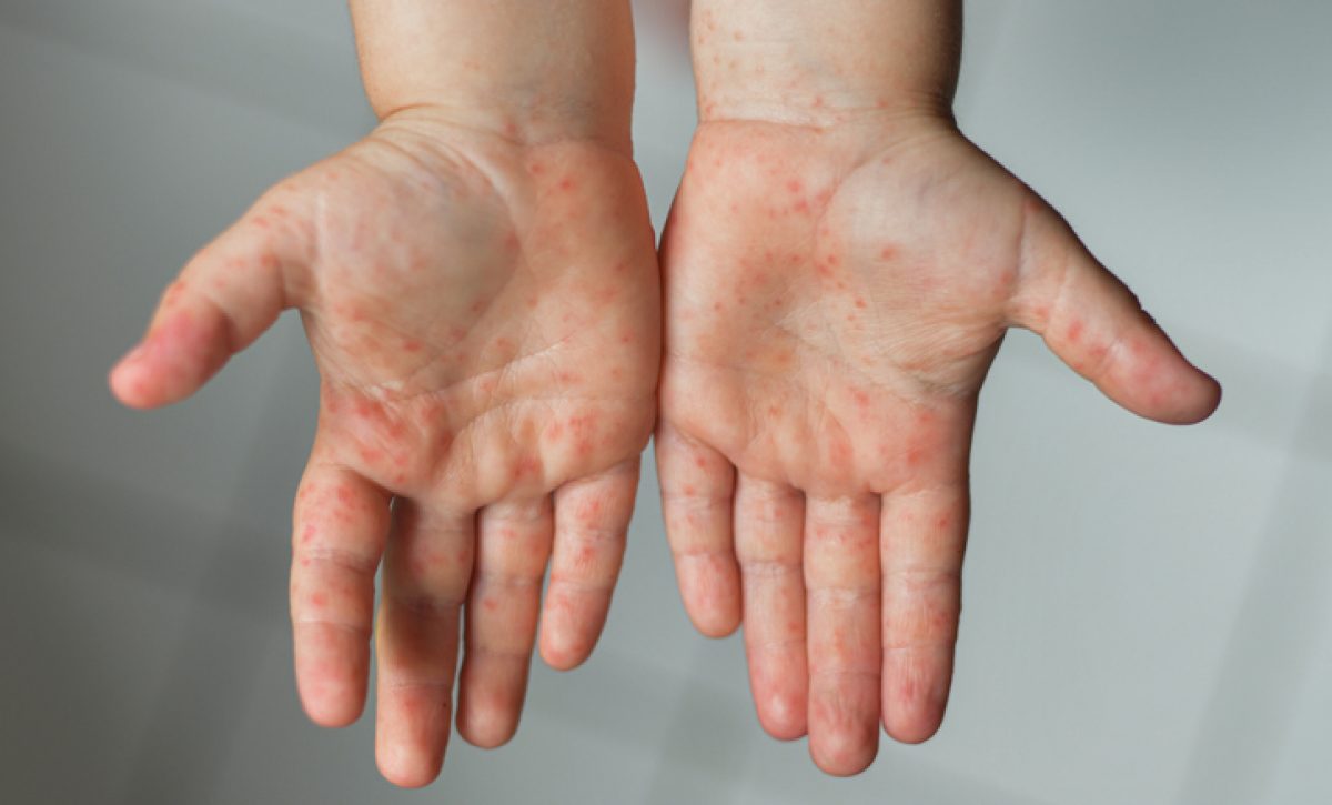 Enterovirus Leg arm mouth Rash on the body of a child Cocksackie virus