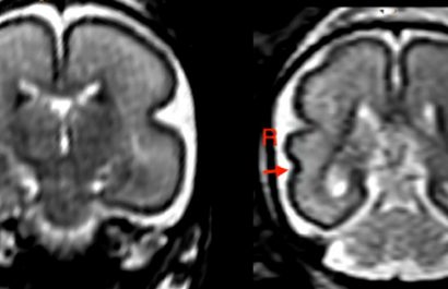 Beber en el embarazo, incluso poco, produce cambios en el cerebro del bebé
