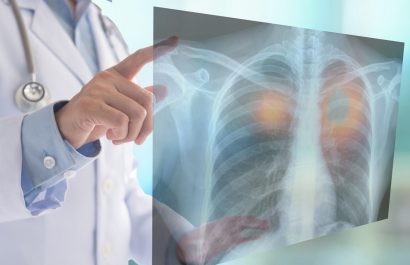 La nueva edición de los 'Diálogos ICAPEM' aborda el uso de los biomarcadores en estadios tempranos de cáncer de pulmón