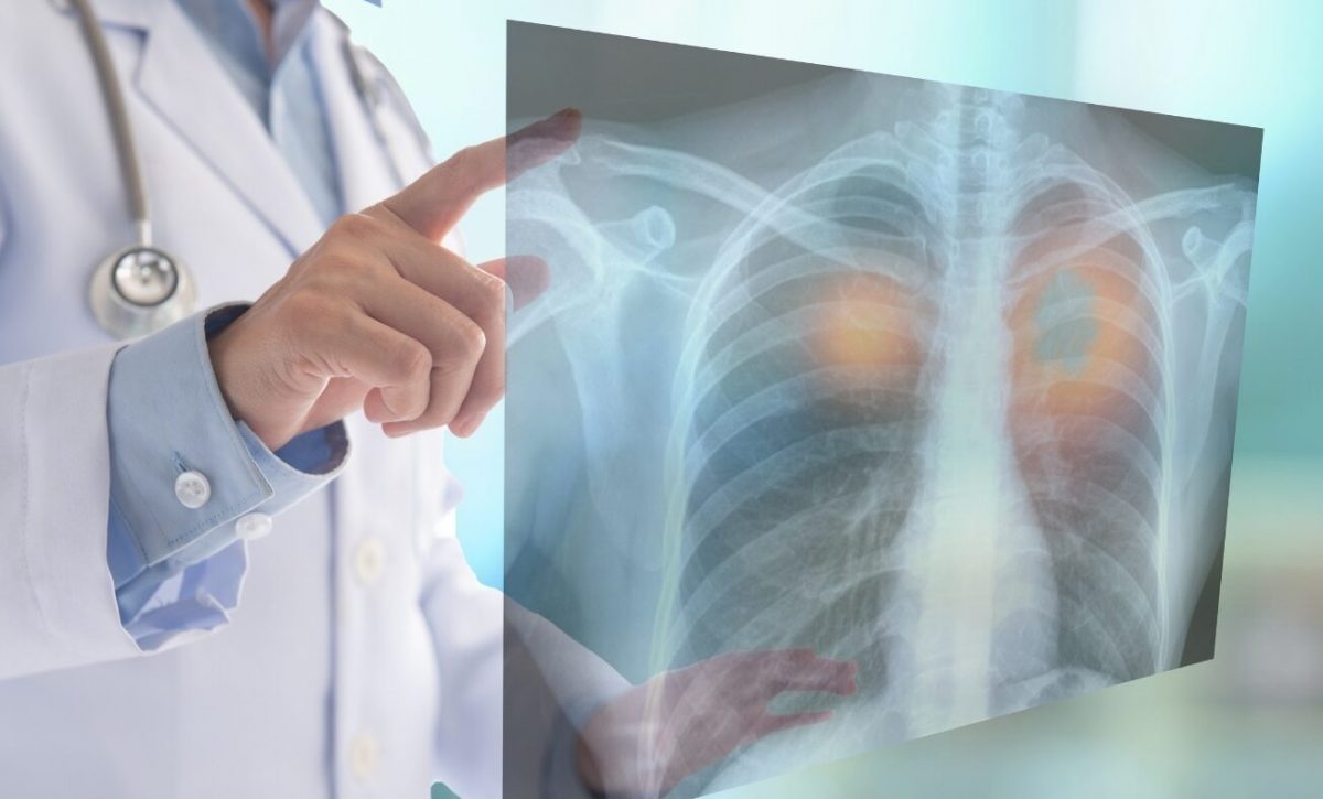 La nueva edición de los 'Diálogos ICAPEM' aborda el uso de los biomarcadores en estadios tempranos de cáncer de pulmón
