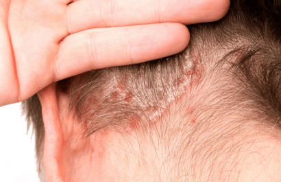 ¿Tiene cura la dermatitis seborreica? Esto dicen los expertos