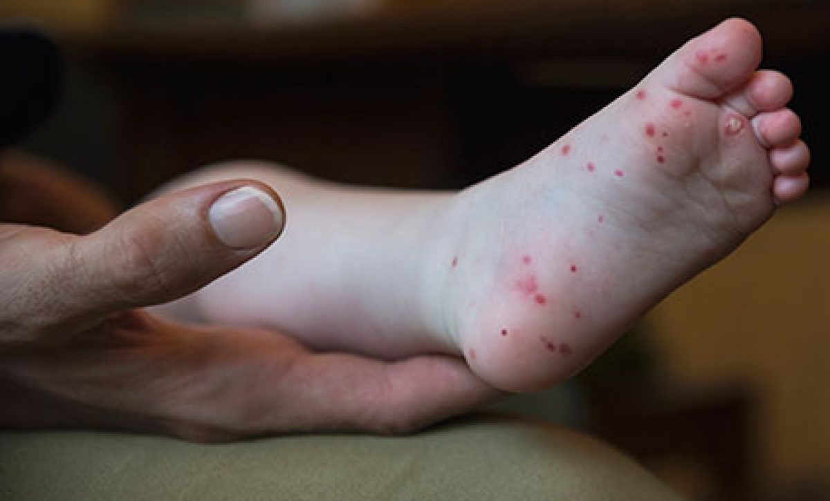 hfmd-childs-foot