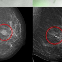 Cáncer de mama: nuevo método para buscar el mejor fármaco