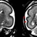 Cerebro fetal tras la exposición al alcohol intrauterino en un feto de entre 25 y 29 semanas de gestación