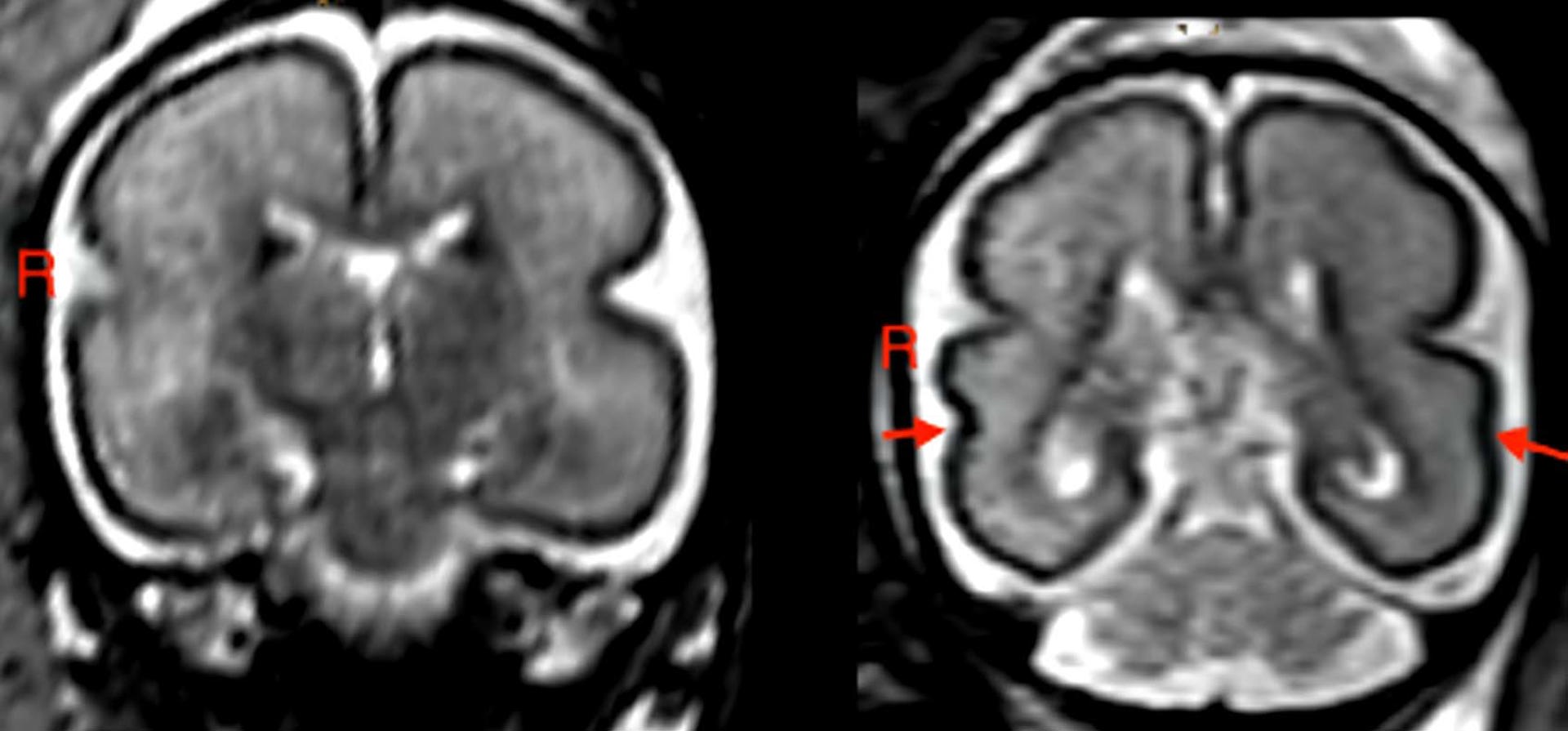 Cerebro fetal tras la exposición al alcohol intrauterino en un feto de entre 25 y 29 semanas de gestación