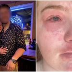 Una mujer ha contado a través de redes sociales que es alérgica a su novio e incluso la alergia  se manifiesta con varios síntomas.