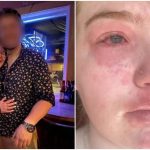 Una mujer ha contado a través de redes sociales que es alérgica a su novio e incluso la alergia  se manifiesta con varios síntomas.