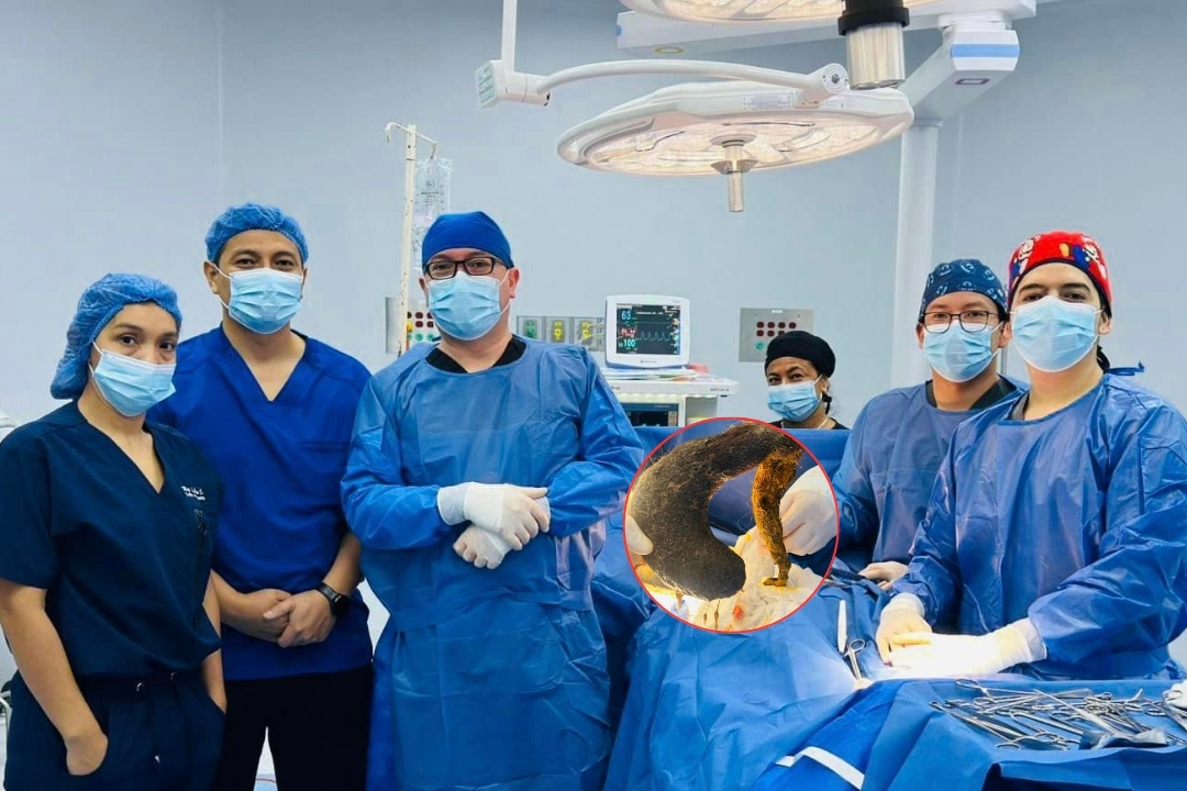 ¡De no creer! Sacan bola de pelos gigante de un estómago, en Portoviejo