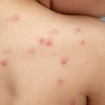 La viruela del mono sigue siendo una emergencia de salud pública de preocupación internacional
