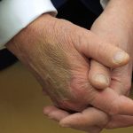 Un moretón en la mano de Donald Trump ha generado especulaciones sobre su salud. La Casa Blanca se pronunció.