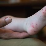 ¿Sabías que la Boca-Mano-Pie se contagia antes de los síntomas?