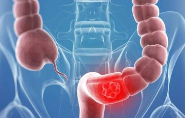 nuevo gen clave para el crecimiento del cáncer de colon