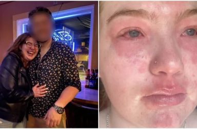 Una mujer ha contado a través de redes sociales que es alérgica a su novio e incluso la alergia  se manifiesta con varios síntomas.