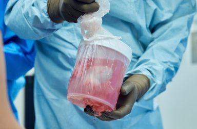 Realizan con éxito un trasplante de riñón de cerdo a un hombre en muerte cerebral
