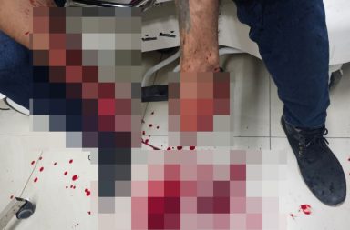 Presunto "vacunador" perdió sus manos al explotar un taco de dinamita en Daule