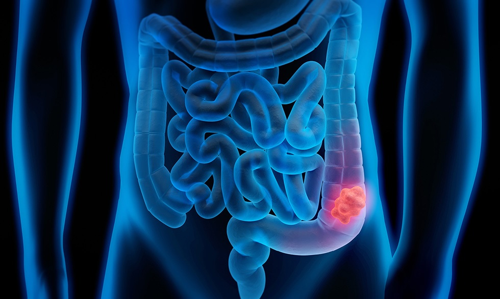 La obesidad y el sedentarismo aumentan el riesgo de cáncer colorrectal
