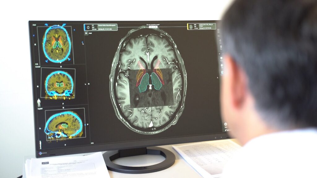 Nuevo hallazgo en fluidos corporales mejora el diagnóstico del Parkinson