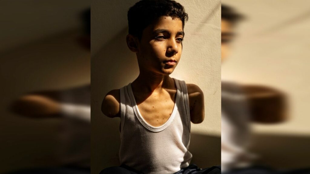 Fotografía de niño mutilado en Gaza gana el World Press Photo 2025