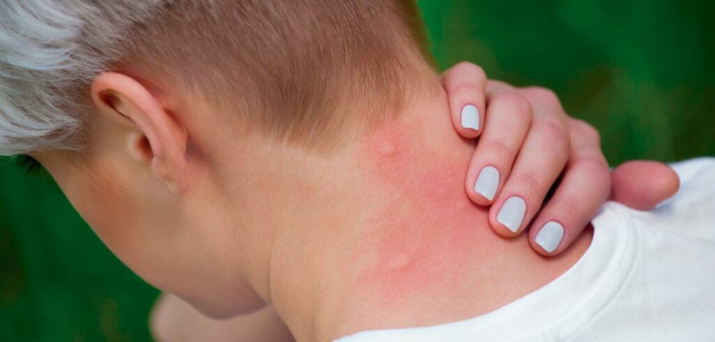 fiebre-amarilla-estos-son-los-sintomas-clave-para-su-deteccion-temprana