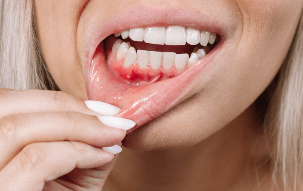 Periodontitis y cáncer colorrectal: una relación más estrecha de lo que parece