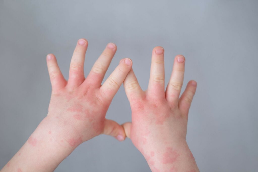 Previene la dermatitis con hidratación