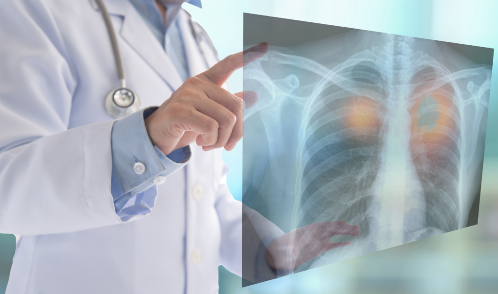 La contaminación del aire promueve el cáncer de pulmón en personas no fumadoras