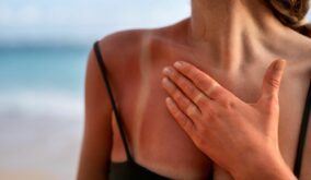 Alertan que broncearse daña la piel y eleva el riesgo de cáncer cutáneo
