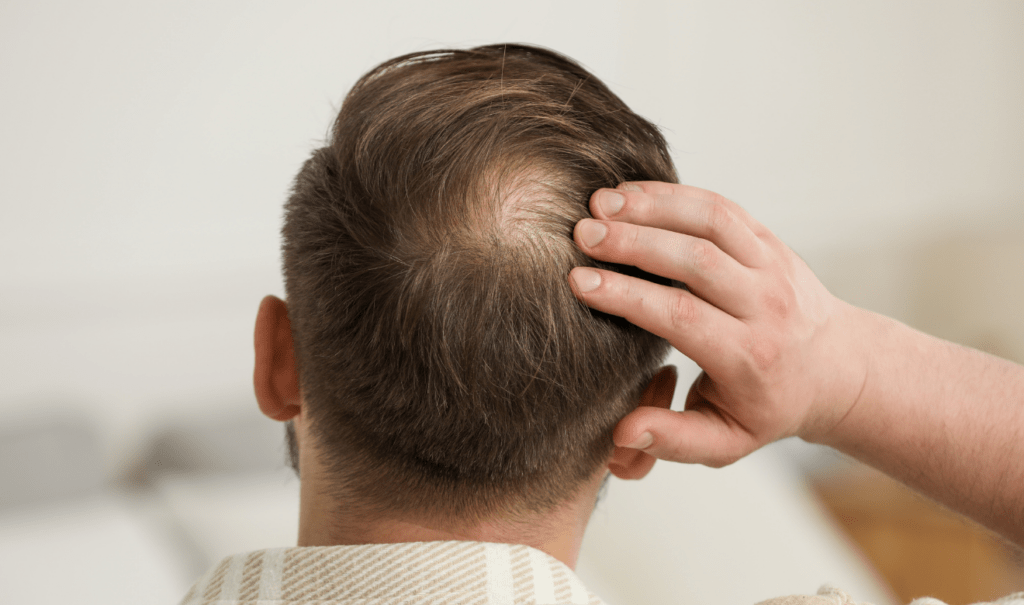 ¿Fin de la calvicie Descubren una molécula que impulsa el crecimiento del cabello