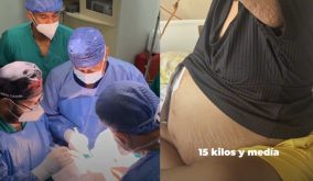 Una mujer vivía con un tumor de 30 libras, la neoplasia le fue extirpada a la paciente en un hospital del IESS en Guayaquil. (IESS)