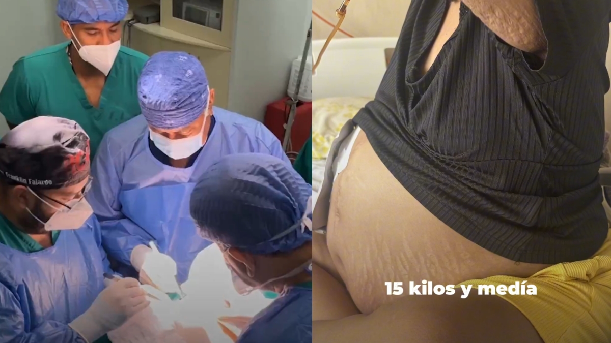 Una mujer vivía con un tumor de 30 libras, la neoplasia le fue extirpada a la paciente en un hospital del IESS en Guayaquil. (IESS)