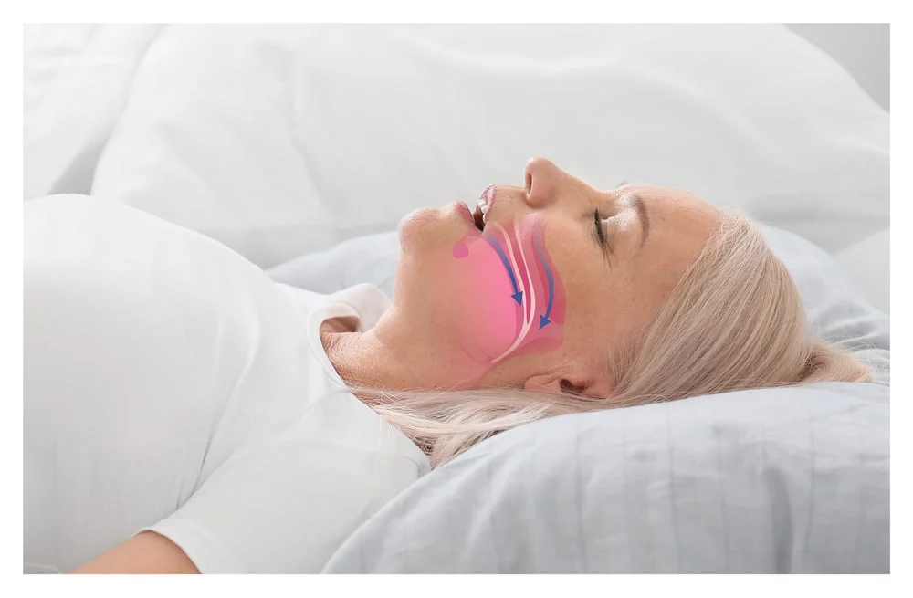 ¿Sufres de cansancio al despertar? Podrías tener apnea. Conoce los síntomas y la importancia del diagnóstico temprano.