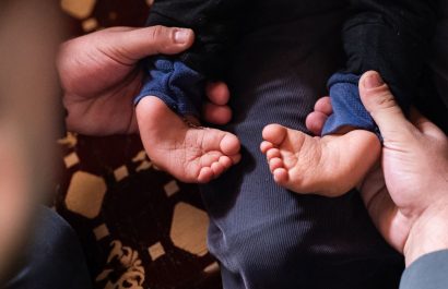 480 bebés nacen con pie equino varo en Ecuador