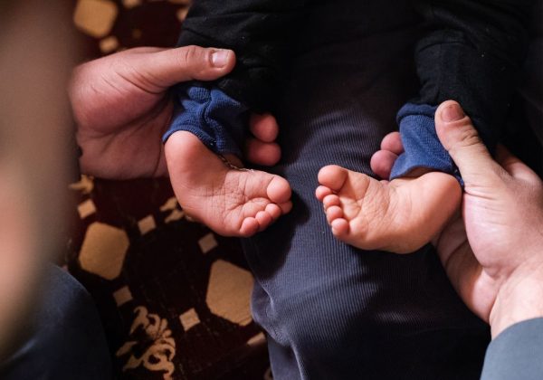 480 bebés nacen con pie equino varo en Ecuador