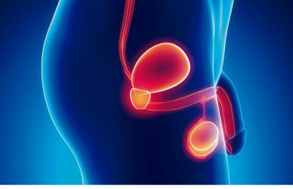 75% de los pacientes de cáncer de próstata logra curarse gracias a un diagnóstico precoz
