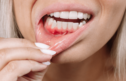Periodontitis y cáncer colorrectal: una relación más estrecha de lo que parece