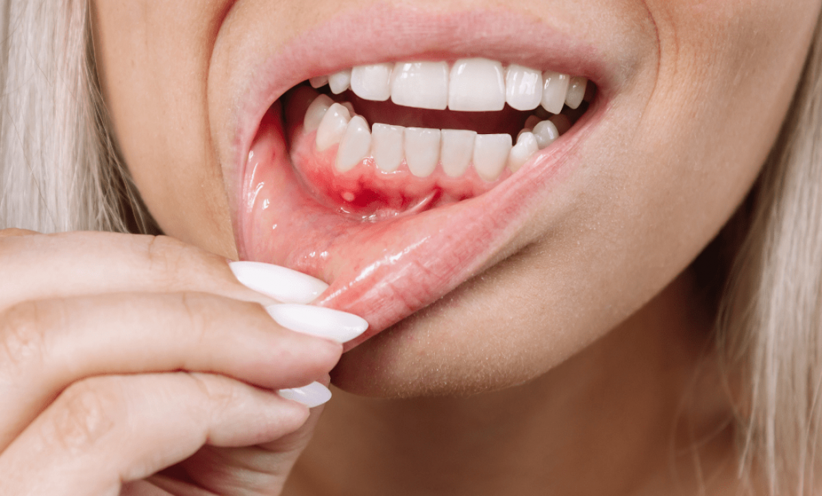 Periodontitis y cáncer colorrectal: una relación más estrecha de lo que parece