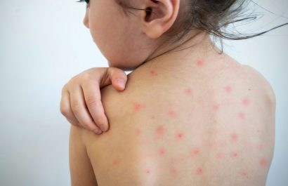 Estados Unidos eleva a 935 los casos de sarampión confirmados en 2025