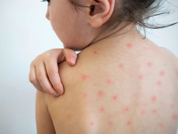 Estados Unidos eleva a 935 los casos de sarampión confirmados en 2025