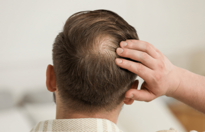 ¿Fin de la calvicie Descubren una molécula que impulsa el crecimiento del cabello