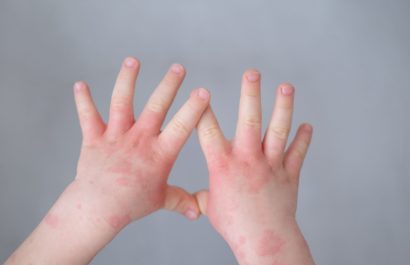 Previene la dermatitis con hidratación