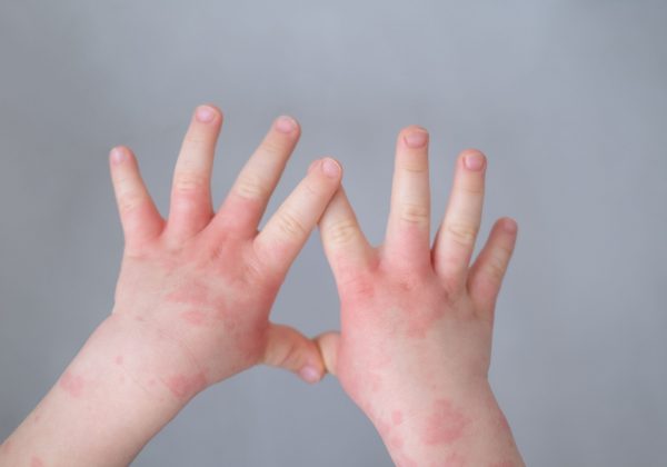 Previene la dermatitis con hidratación