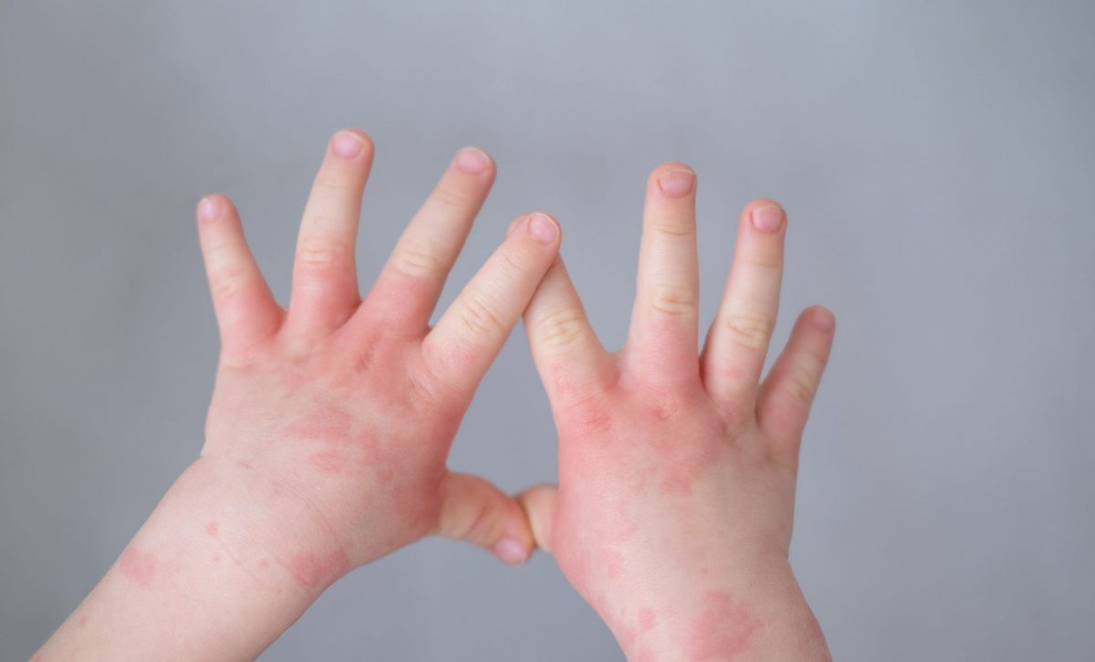 Previene la dermatitis con hidratación
