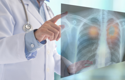 La contaminación del aire promueve el cáncer de pulmón en personas no fumadoras
