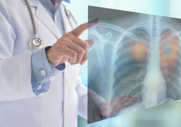 La contaminación del aire promueve el cáncer de pulmón en personas no fumadoras