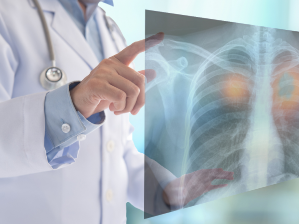 La contaminación del aire promueve el cáncer de pulmón en personas no fumadoras